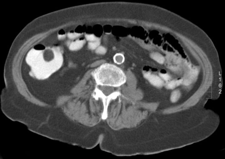 File:Ascending colon lipoma (Radiopaedia 2582-6276 Axial liver window 1).jpg