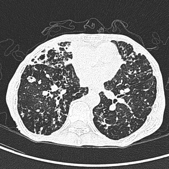 File:Aspergilloma- with Monod sign (Radiopaedia 44737-48532 Axial lung window 163).jpg
