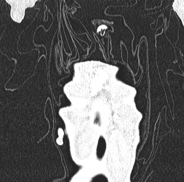 Aspergilloma- with Monod sign (Radiopaedia 44737-48532 Coronal lung window 107).jpg
