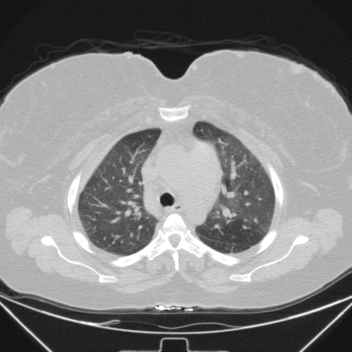 Aspergilloma (Radiopaedia 39611-41932 Axial lung window 38).jpg