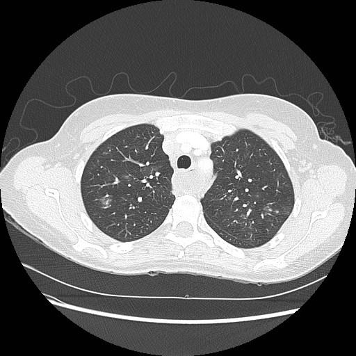 Aspiration pneumonia secondary to laparoscopic banding (Radiopaedia 18345-18183 lung window 25).jpg