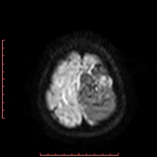 Astroblastoma (Radiopaedia 74287-85162 Axial DWI 97).jpg