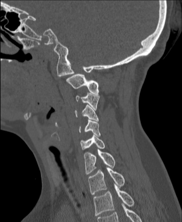 Atlanto-occipital assimilation with basilar invagination (Radiopaedia 70122-80188 Sagittal bone window 99).jpg