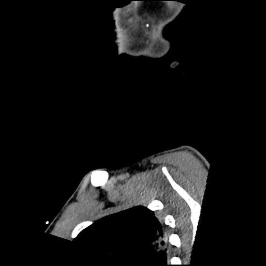 Atlanto-occipital dissociation (Traynelis type 1), C2 teardrop fracture, C6-7 facet joint dislocation (Radiopaedia 87655-104061 D 4).jpg