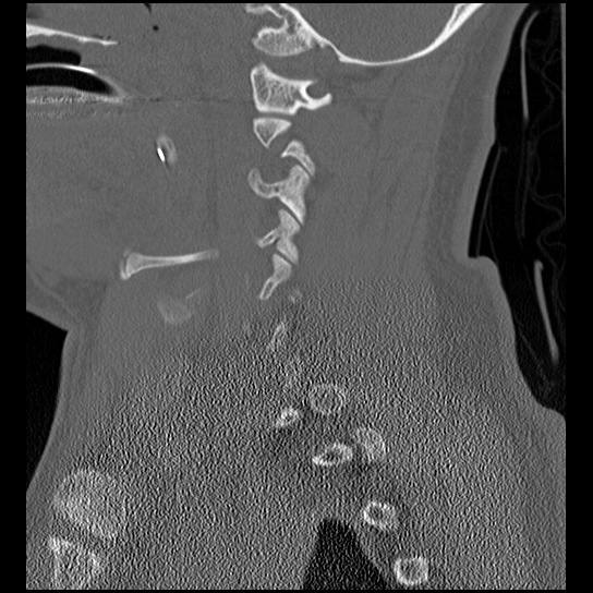 Atlanto-occipital dissociation injury (Radiopaedia 29274-29698 Sagittal bone window 18).png
