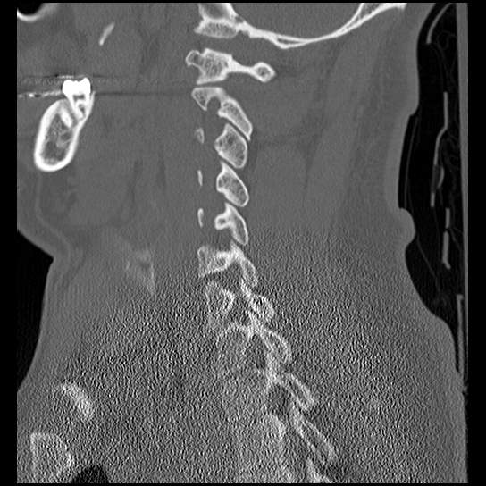 Atlanto-occipital dissociation injury (Radiopaedia 29274-29698 Sagittal bone window 38).png