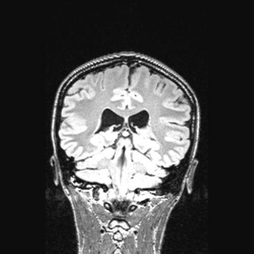 File:Atretic encephalocoele with inferior vermis hypoplasia (Radiopaedia 30443-31108 Coronal FLAIR 73).jpg