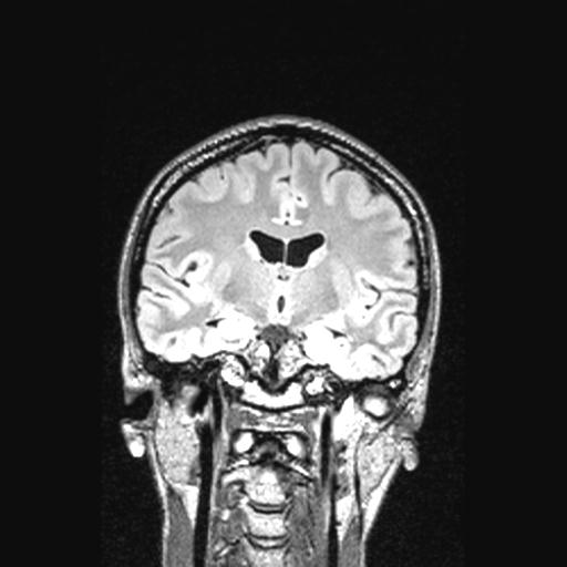 Atretic encephalocoele with inferior vermis hypoplasia (Radiopaedia 30443-31108 Coronal FLAIR 99).jpg