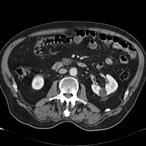 File:Atypical hepatocellular carcinoma (Radiopaedia 41744-44698 B 52).jpg