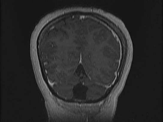 Atypical meningioma (Radiopaedia 62985-71406 Coronal T1 C+ 106).jpg