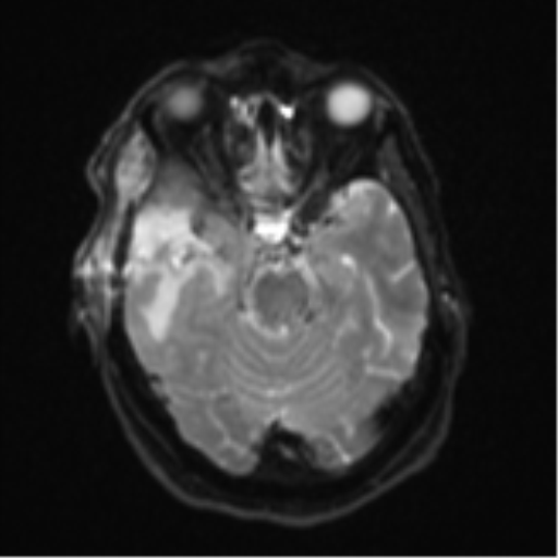 File:Atypical meningioma (WHO Grade II) (Radiopaedia 54742-60981 Axial DWI 10).png