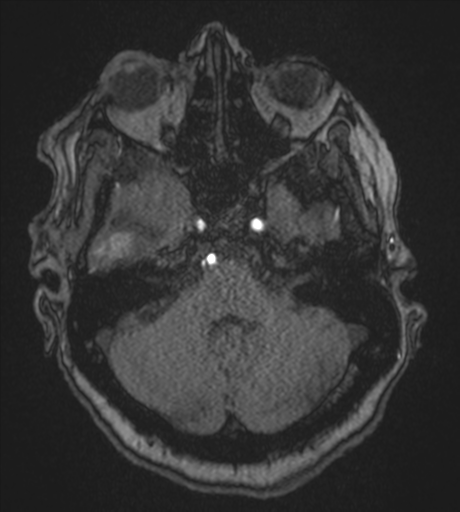 Atypical meningioma (WHO Grade II) (Radiopaedia 54742-60981 Axial MRA 24).png