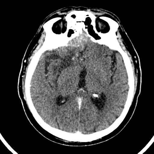Atypical meningioma (WHO grade II) with brain invasion (Radiopaedia 57767-64728 Axial C+ 30).png
