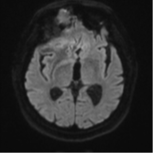 Atypical meningioma (WHO grade II) with brain invasion (Radiopaedia 57767-64729 Axial DWI 44).png
