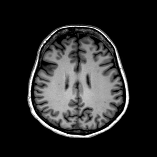 Autoimmune limbic encephalitis (Radiopaedia 30363-31005 T1 Axial 1mm 100).jpg