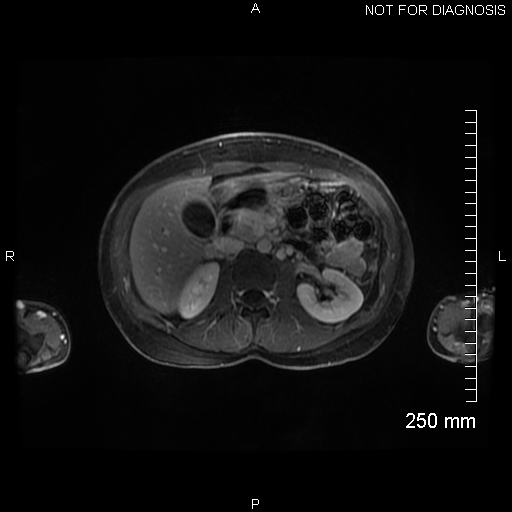 File:Autoimmune pancreatitis (Radiopaedia 88443-105101 A 71).jpg