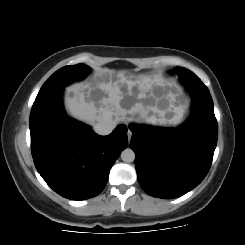 Autosomal dominant polycystic kidney disease (Radiopaedia 23061-23093 C+ delayed 6).jpg