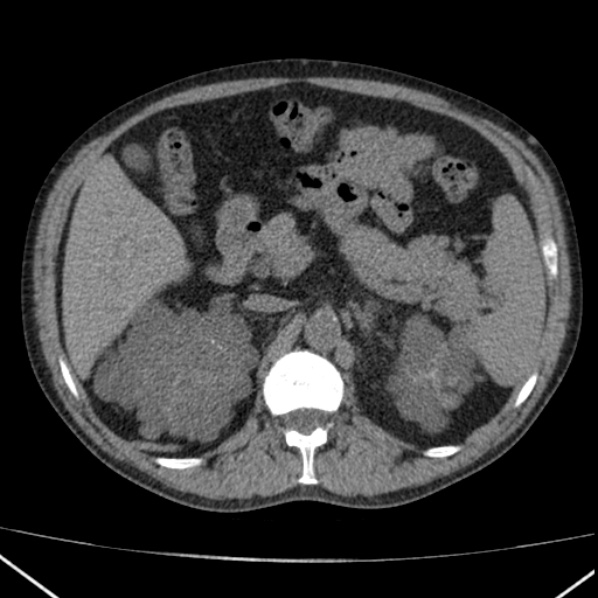 File:Autosomal dominant polycystic kidney disease (Radiopaedia 36539-38101 Axial non-contrast 28).jpg