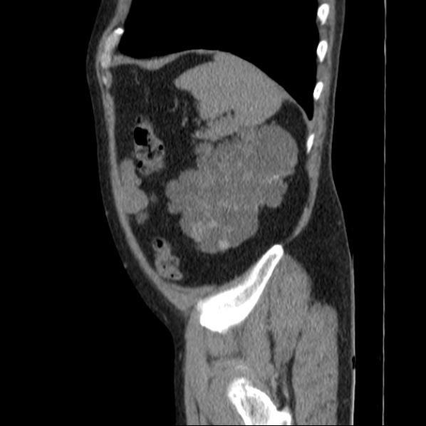 File:Autosomal dominant polycystic kidney disease (Radiopaedia 36539-38101 D 69).jpg