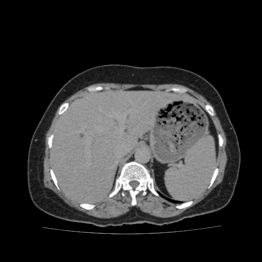 Autosomal dominant polycystic kidney disease (Radiopaedia 38189-40194 Axial C+ delayed 7).jpg