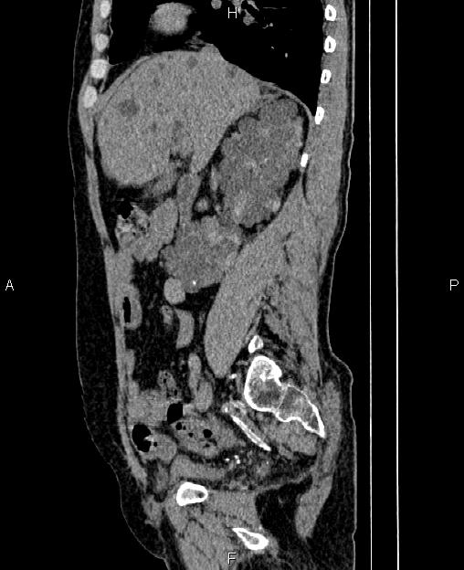 Autosomal dominant polycystic kidney disease (Radiopaedia 87830-104287 C 32).jpg