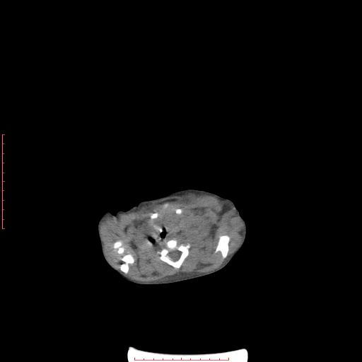 File:Autosomal recessive polycystic kidney disease associated with Caroli disease (Radiopaedia 61932-69984 Axial non-contrast 10).jpg