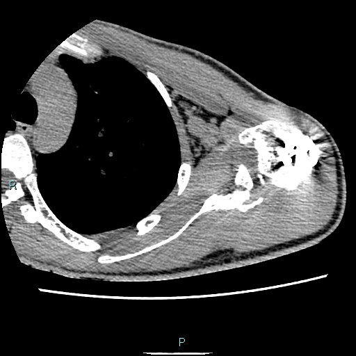 File:Avascular necrosis after fracture dislocations of the proximal humerus (Radiopaedia 88078-104653 D 47).jpg