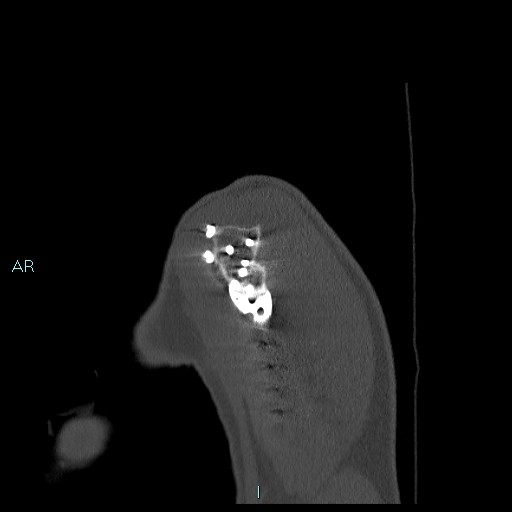 File:Avascular necrosis after fracture dislocations of the proximal humerus (Radiopaedia 88078-104655 Sagittal bone window 10).jpg
