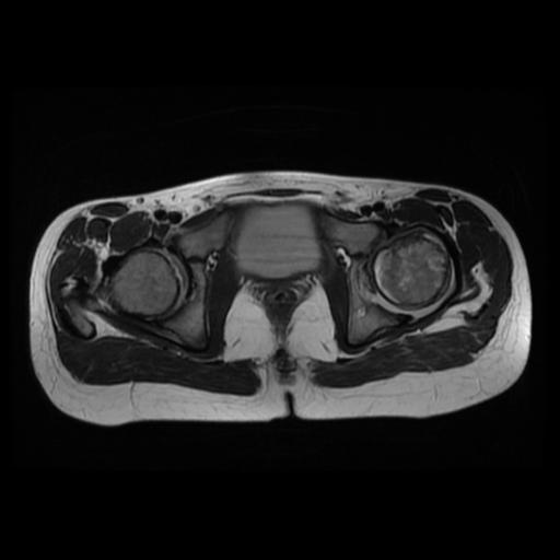 File:Avascular necrosis of the hip (Radiopaedia 29563-30067 Axial T2 9).jpg