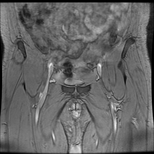 Avascular necrosis of the hip (Radiopaedia 61503-69465 F 10).jpg