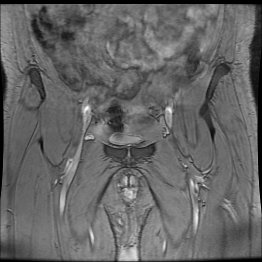 Avascular necrosis of the hip (Radiopaedia 61503-69465 F 11).jpg