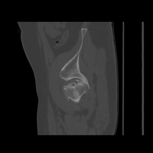 Avascular necrosis of the hip (Radiopaedia 61503-69467 B 49).jpg