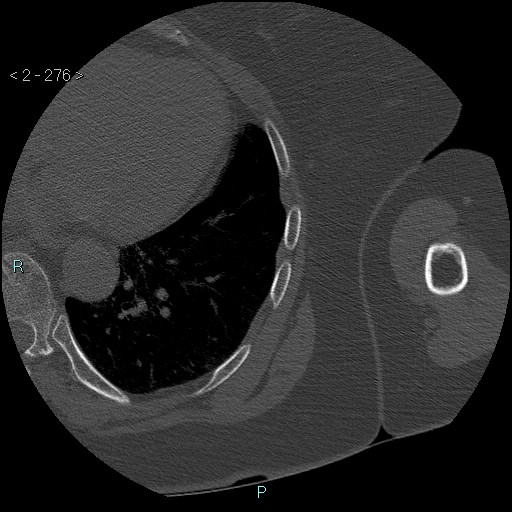 File:Avascular necrosis of the shoulder - Cruess stage I (Radiopaedia 77674-89887 Axial bone window 69).jpg