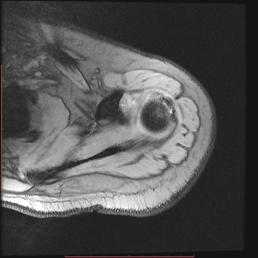 File:Avulsion fracture - greater tuberosity of humerus (Radiopaedia 25457-25703 Axial Gradient Echo 6).jpg