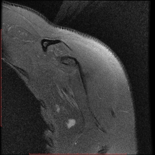 File:Avulsion fracture - greater tuberosity of humerus (Radiopaedia 25457-25703 Coronal PD 1).jpg