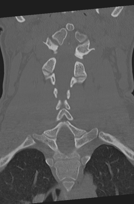 Axis peg fracture (type 3) and atlas lateral mass (type 4) fracture (Radiopaedia 37474-39324 Coronal bone window 26).png