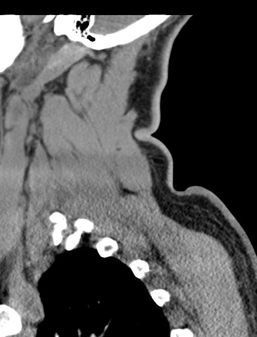 Axis peg fracture (type 3) and atlas lateral mass (type 4) fracture (Radiopaedia 37474-39324 D 65).png
