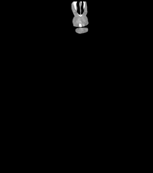 Azygos arch valve (Radiopaedia 39866-42334 B 4).jpg