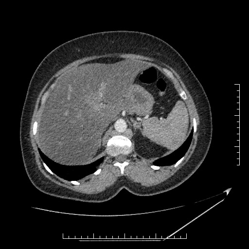 File:Azygos continuation of the IVC (Radiopaedia 40416-42965 A 20).jpg