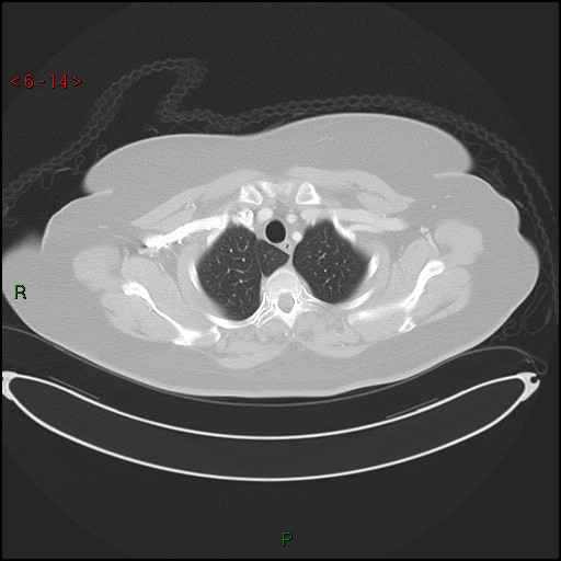 Azygos fissure and lobe (Radiopaedia 47620-52278 Axial lung window 14).jpg