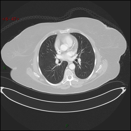 File:Azygos fissure and lobe (Radiopaedia 47620-52278 Axial lung window 47).jpg