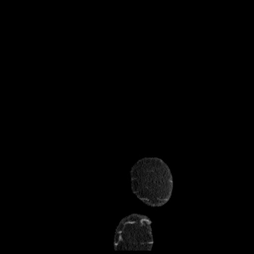 B-cell lymphoma of the mesentery (Radiopaedia 65711-74827 C 6).jpg