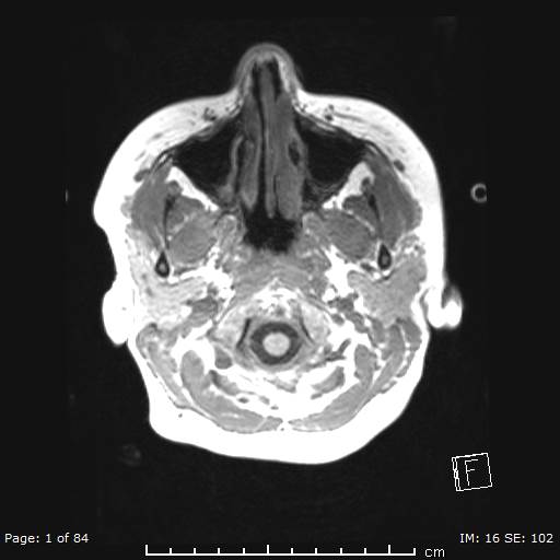 File:Balo concentric sclerosis (Radiopaedia 61637-69636 Axial T1 1).jpg