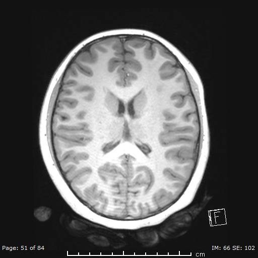 Balo concentric sclerosis (Radiopaedia 61637-69636 Axial T1 51).jpg