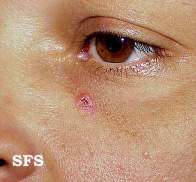 Basal Cell Carcinoma (Dermatology Atlas 9).jpg