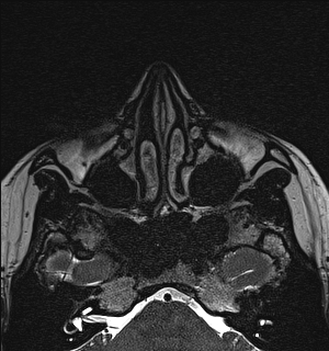 File:Basal cell carcinoma - nasal region (Radiopaedia 70292-80365 Axial Gradient Echo 42).jpg