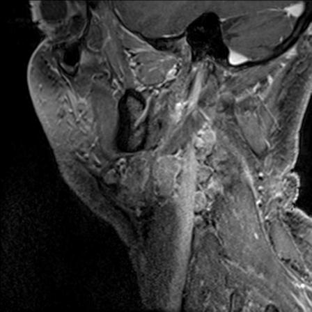 Base of tongue squamous cell carcinoma (Radiopaedia 31174-31884 F 140).jpg