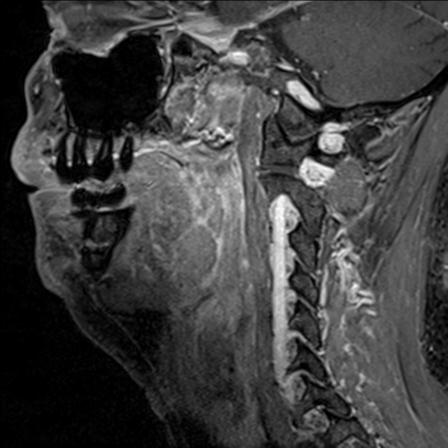 Base of tongue squamous cell carcinoma (Radiopaedia 31174-31884 F 66).jpg