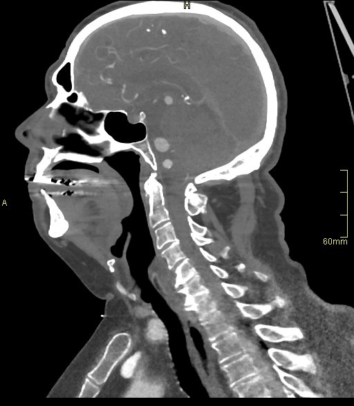 Basilar artery aneurysm (Radiopaedia 56261-62932 C 29).jpg