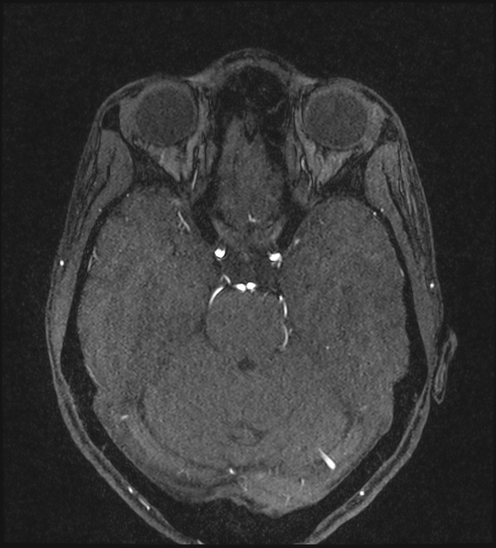 Basilar artery perforator aneurysm (Radiopaedia 82455-97733 Axial MRA 92).jpg